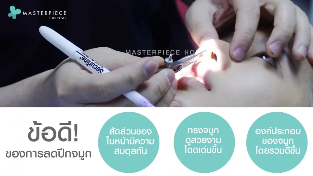 只割鼻翼不隆鼻能美吗?