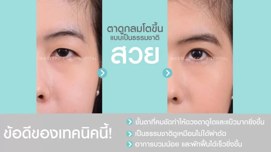 进行双眼皮手术时,哪种方法最适合您?