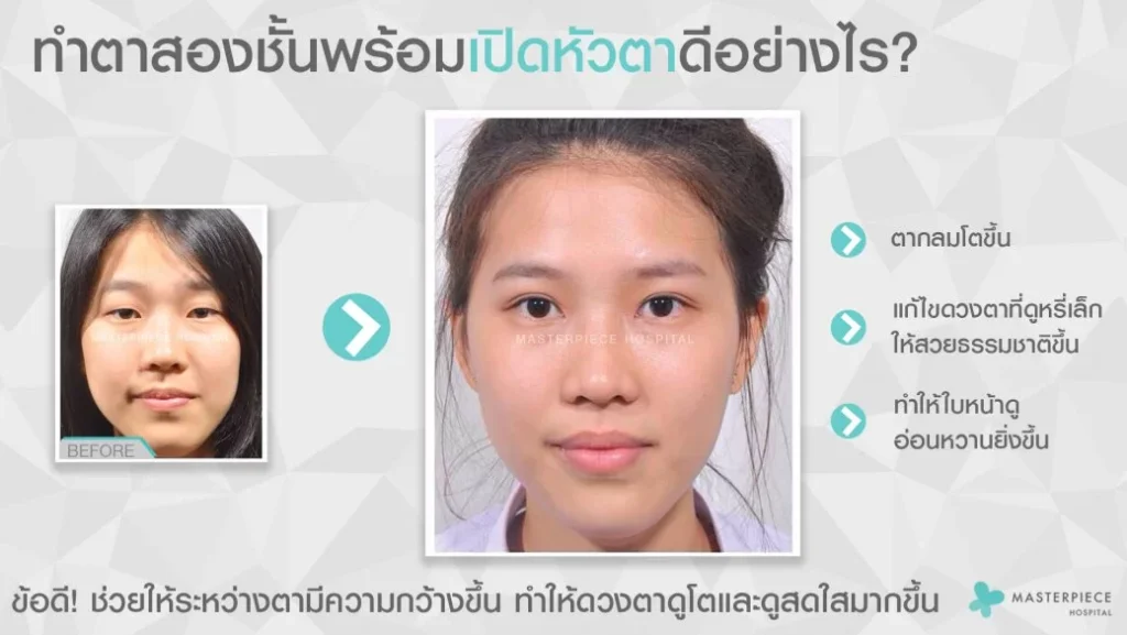 眼睑手术有助于使眼睛变大。让小眼睛变大。让你的脸变得甜美而清澈。