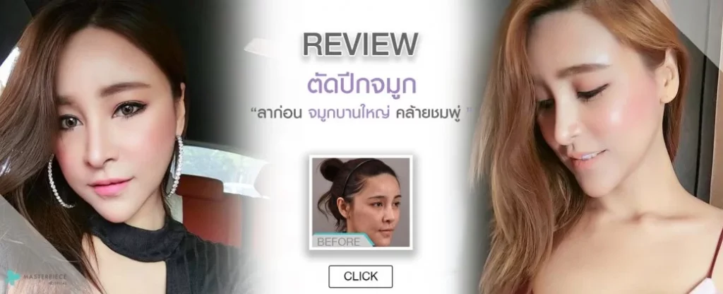 回顾鼻皮瓣手术