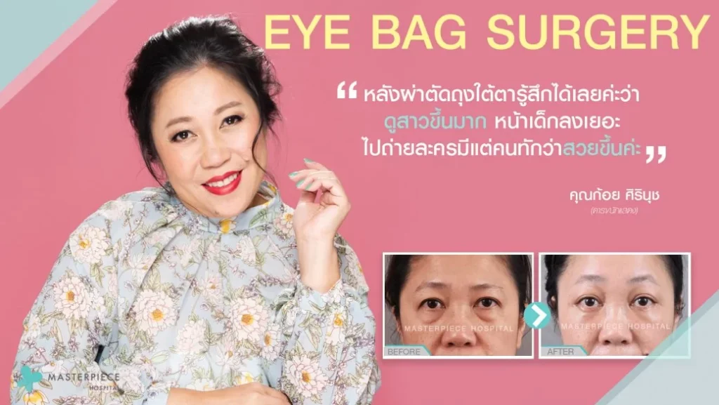 眼袋手术,让你返老还童,让你看起来又明亮又年轻!