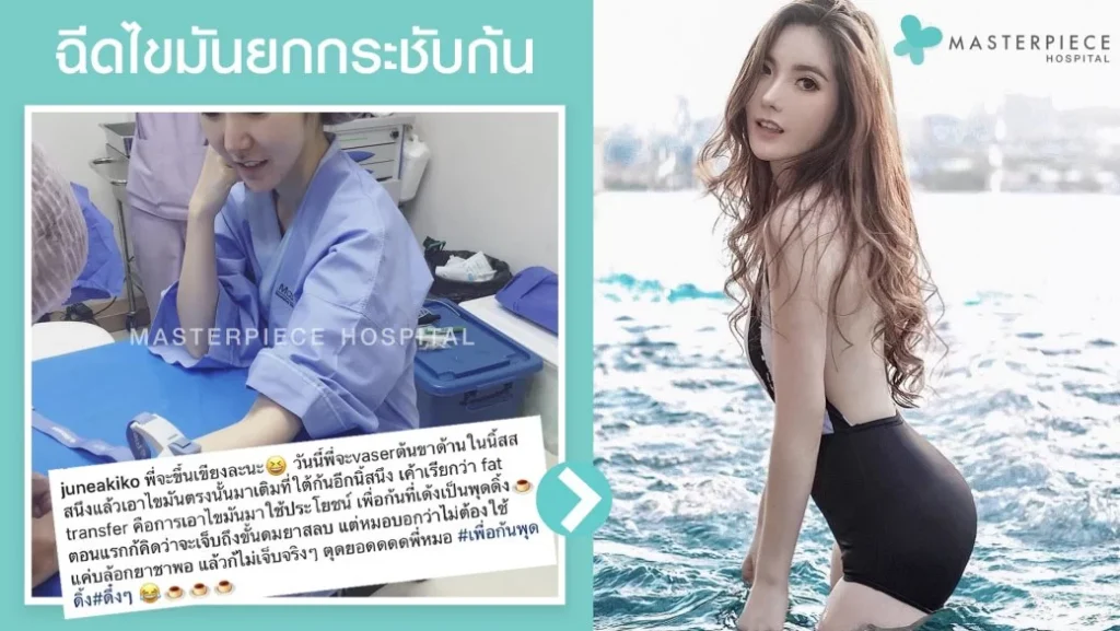 自体脂肪注射、臀部紧致