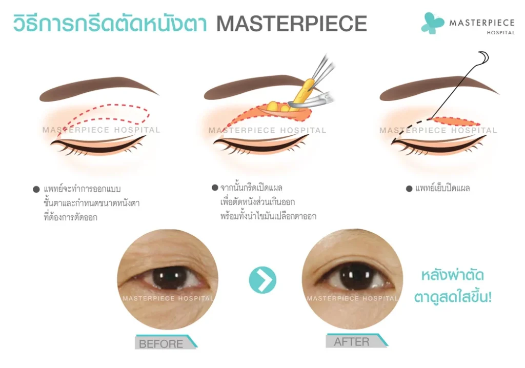 通过手术矫正下垂眼睑的步骤