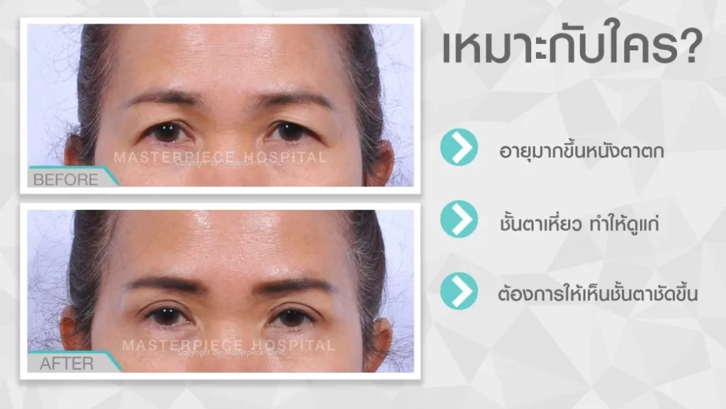 แก้หนังตาตก เหมาะกับผู้ที่มีปัญหาหนังตาตกจากที่อายุที่มากขึ้น