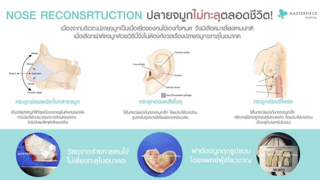 鼻子重建无硅鼻子是利用体内添加的软骨来代替硅树脂。