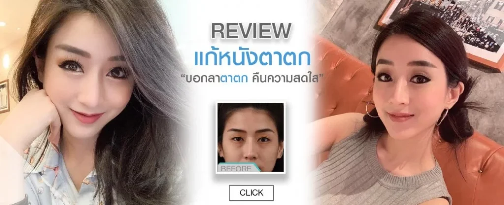 眼睑下垂的检查让你的眼睛看起来明亮,不疲倦,不悲伤。