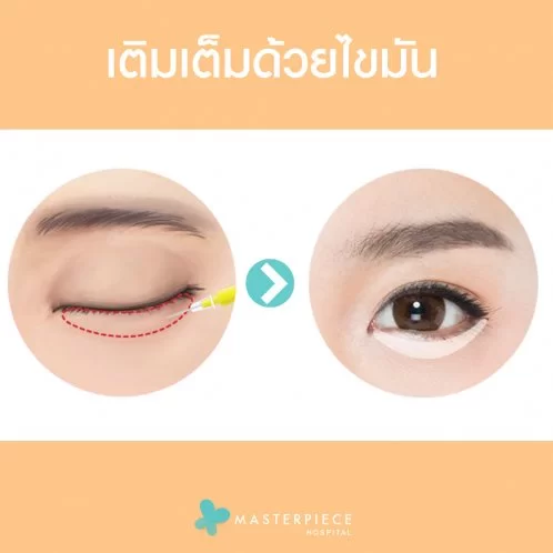 使用 DOLLY EYES 脂肪填充技术填充眼下层。