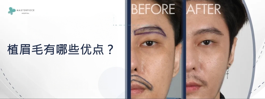 眉毛移植手术有哪些优点？

