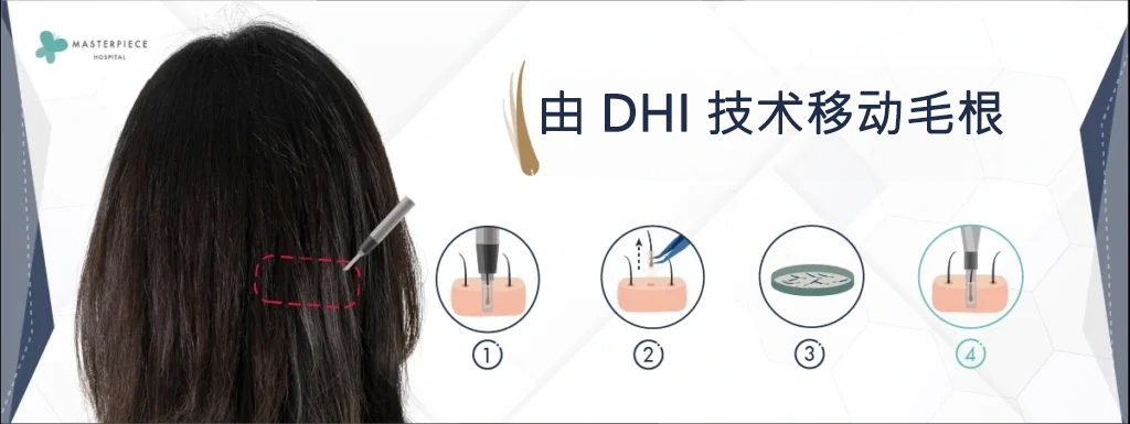 DHI 技术毛根移植
