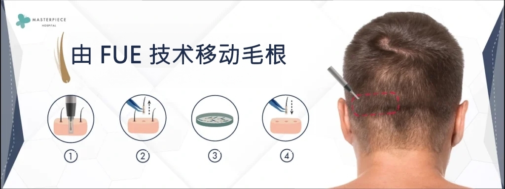 FUE 技术毛根移植
