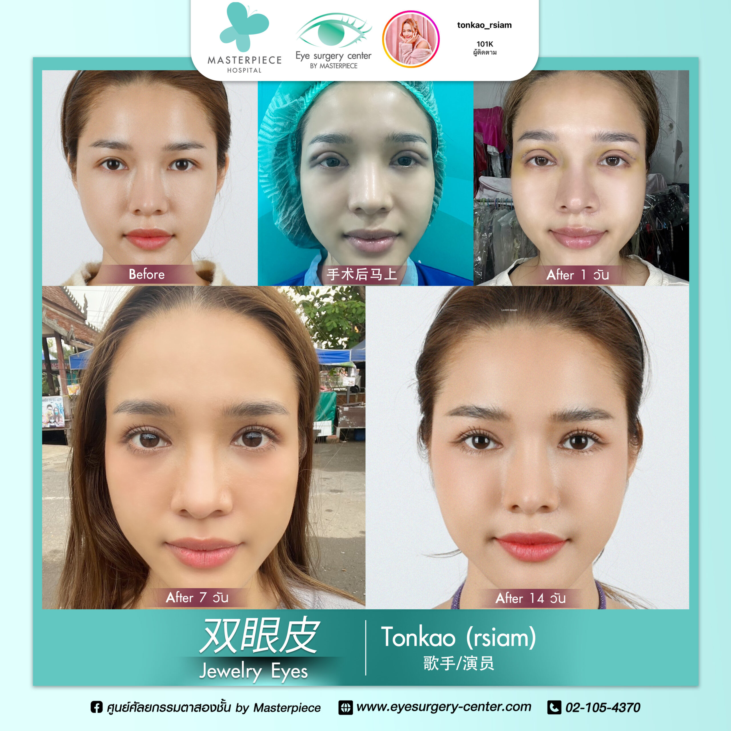 眼睛手术的案例