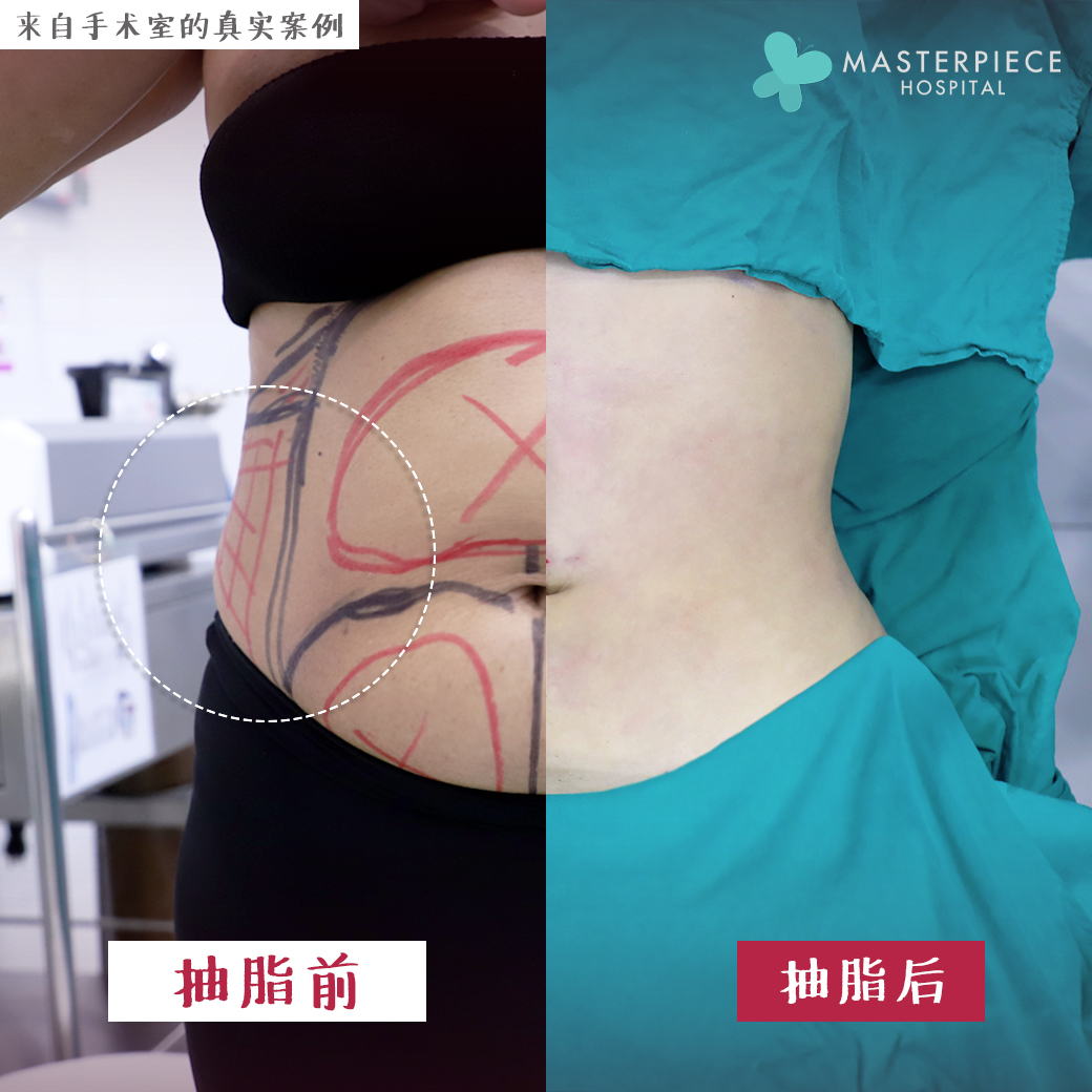 抽脂肪手术的案例