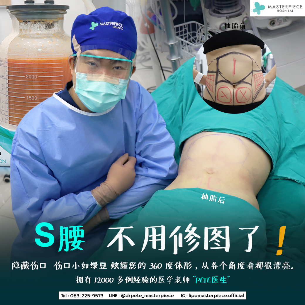 抽脂肪手术的案例