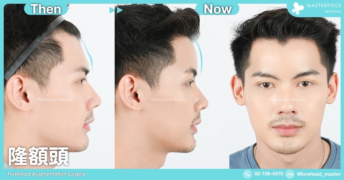 隆额头手术的案例