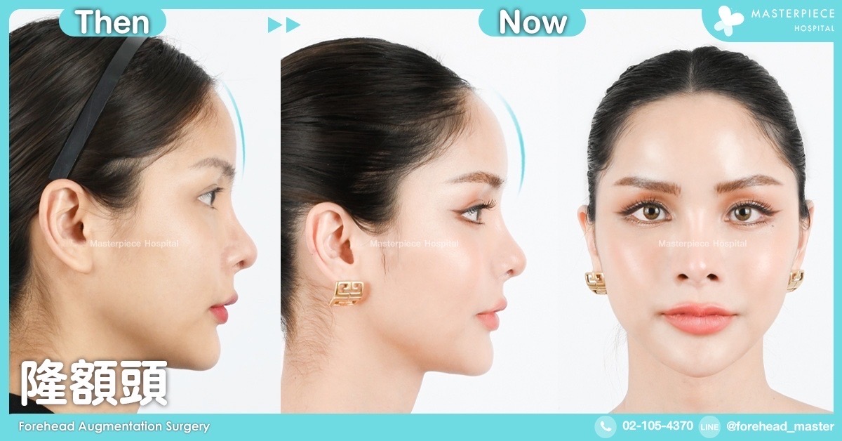 隆额头手术的案例