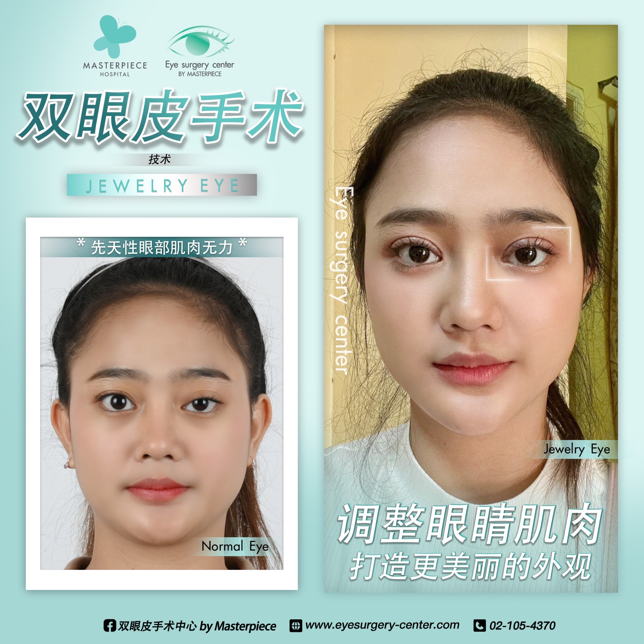 眼睛手术的案例