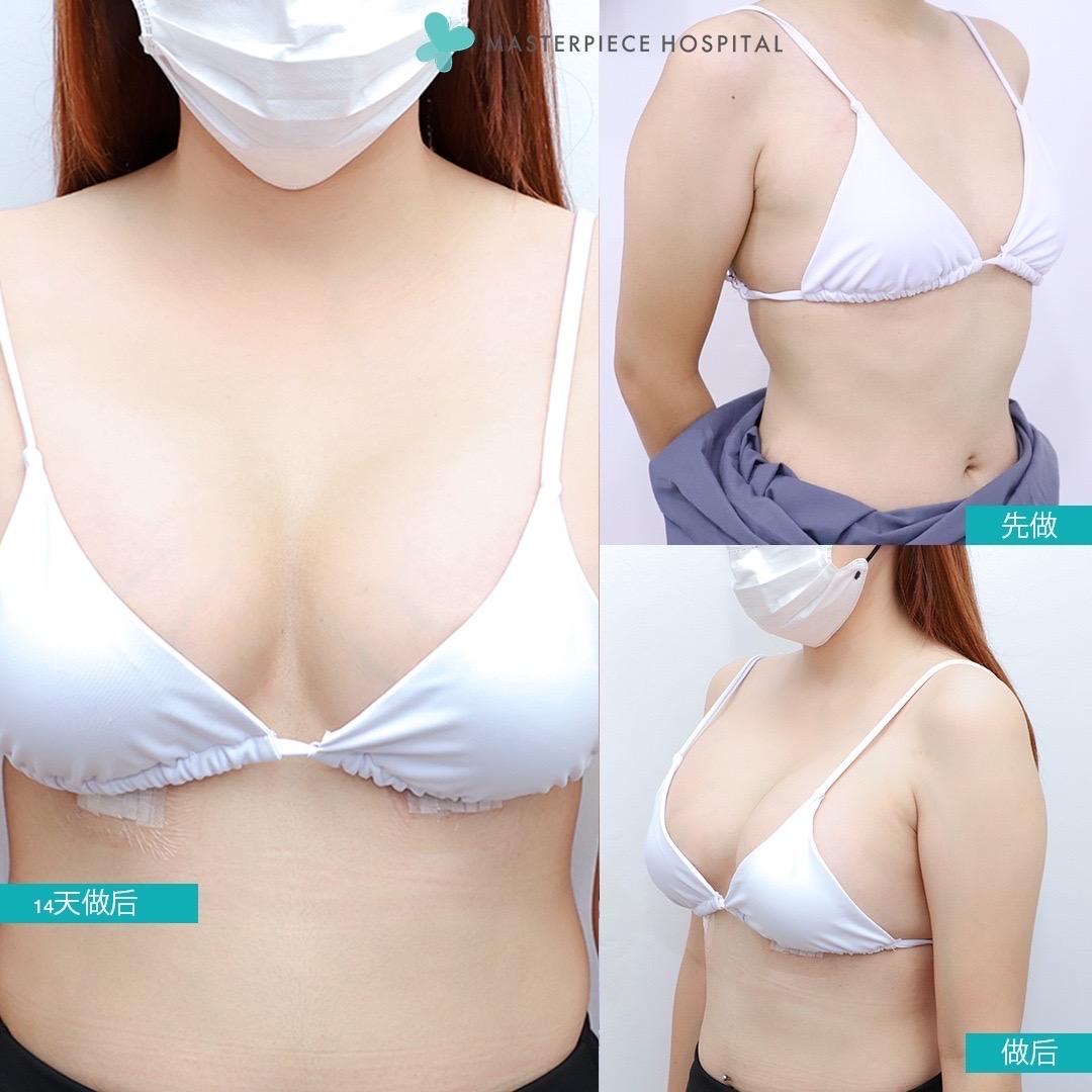 隆胸手术的案例