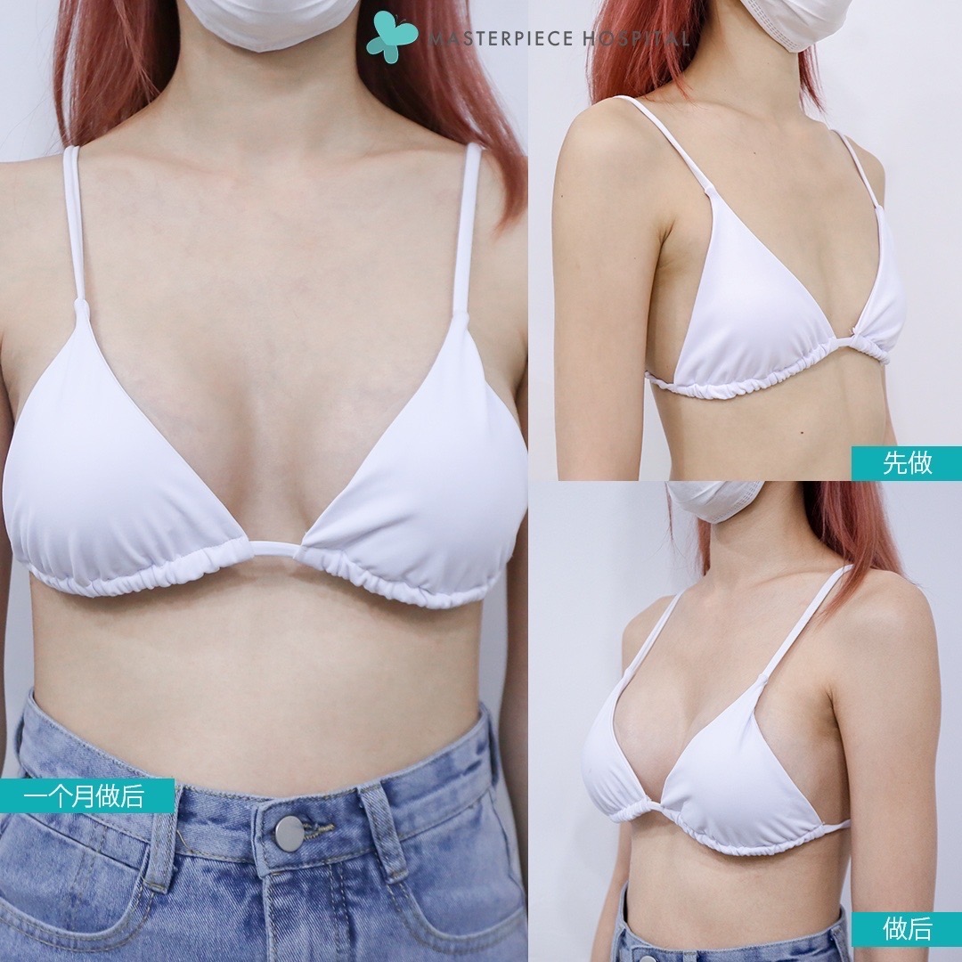 隆胸手术的案例