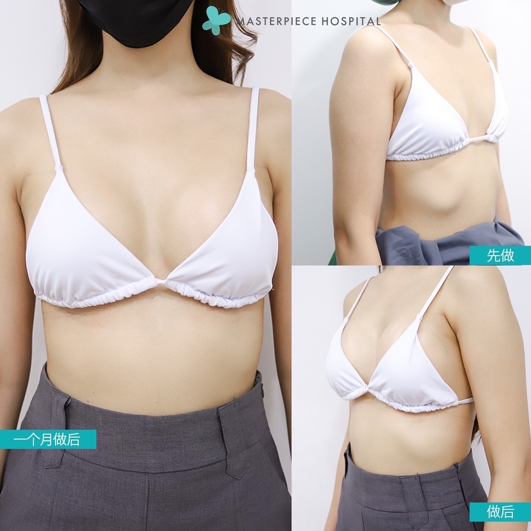 隆胸手术的案例