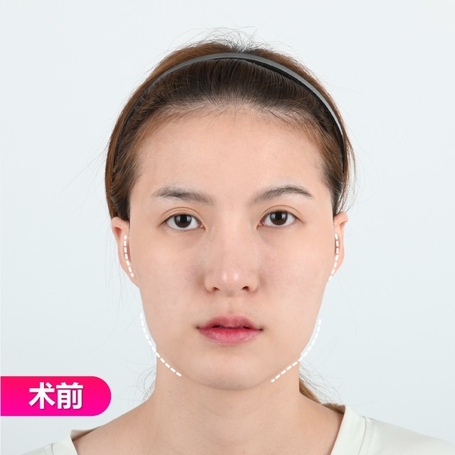 面部整形手术的案例