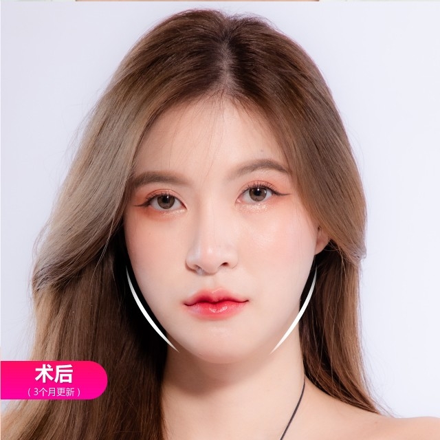 面部整形手术的案例