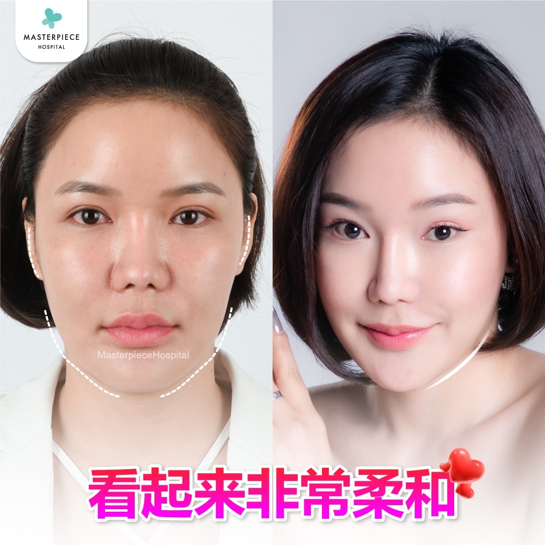 面部整形手术的案例