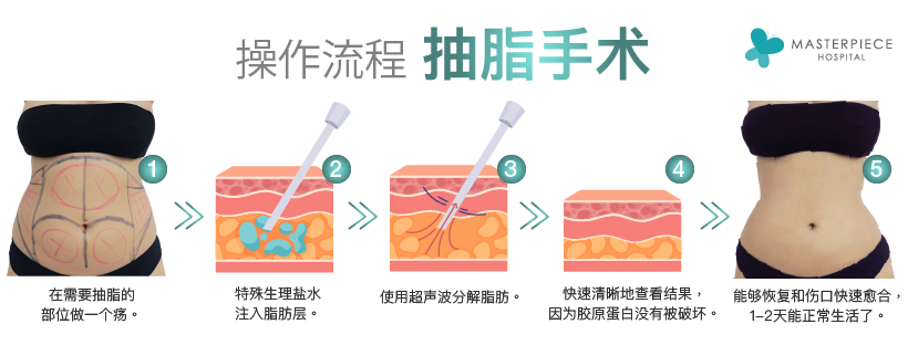 操作流程抽脂手术