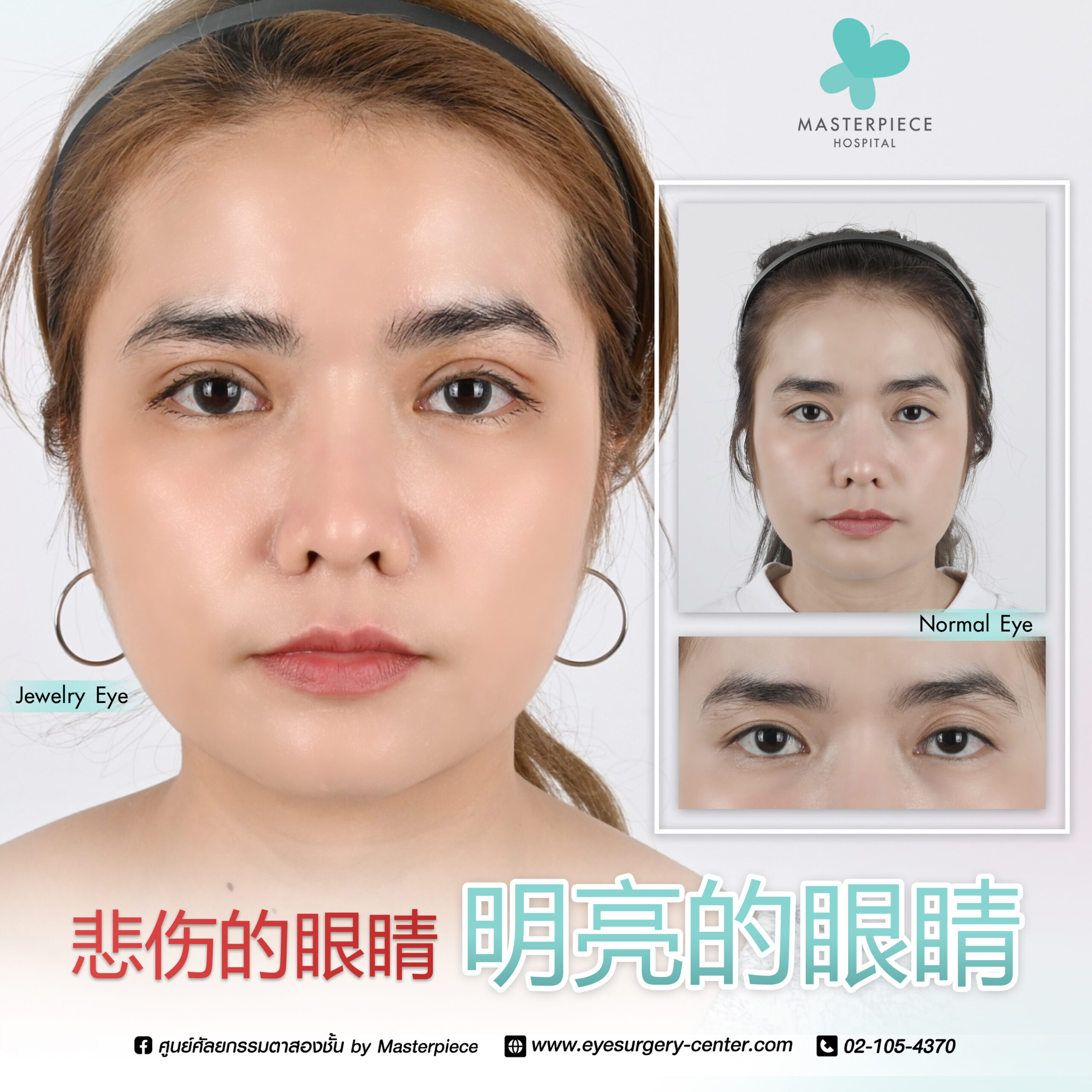 眼睛手术的案例