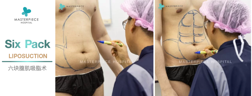六块腹肌抽脂手术后的结果