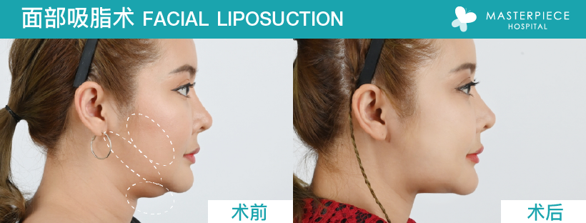 面部吸脂术