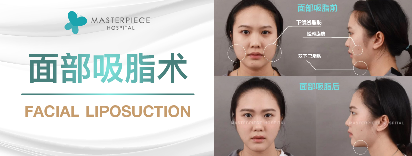 面部吸脂术