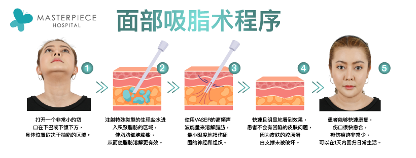 面部吸脂术程序