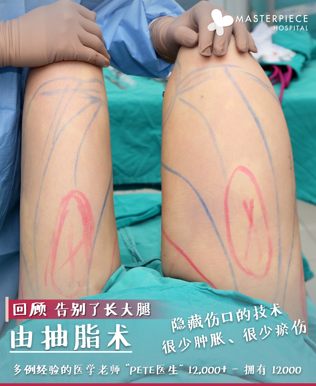 抽脂肪手术的案例