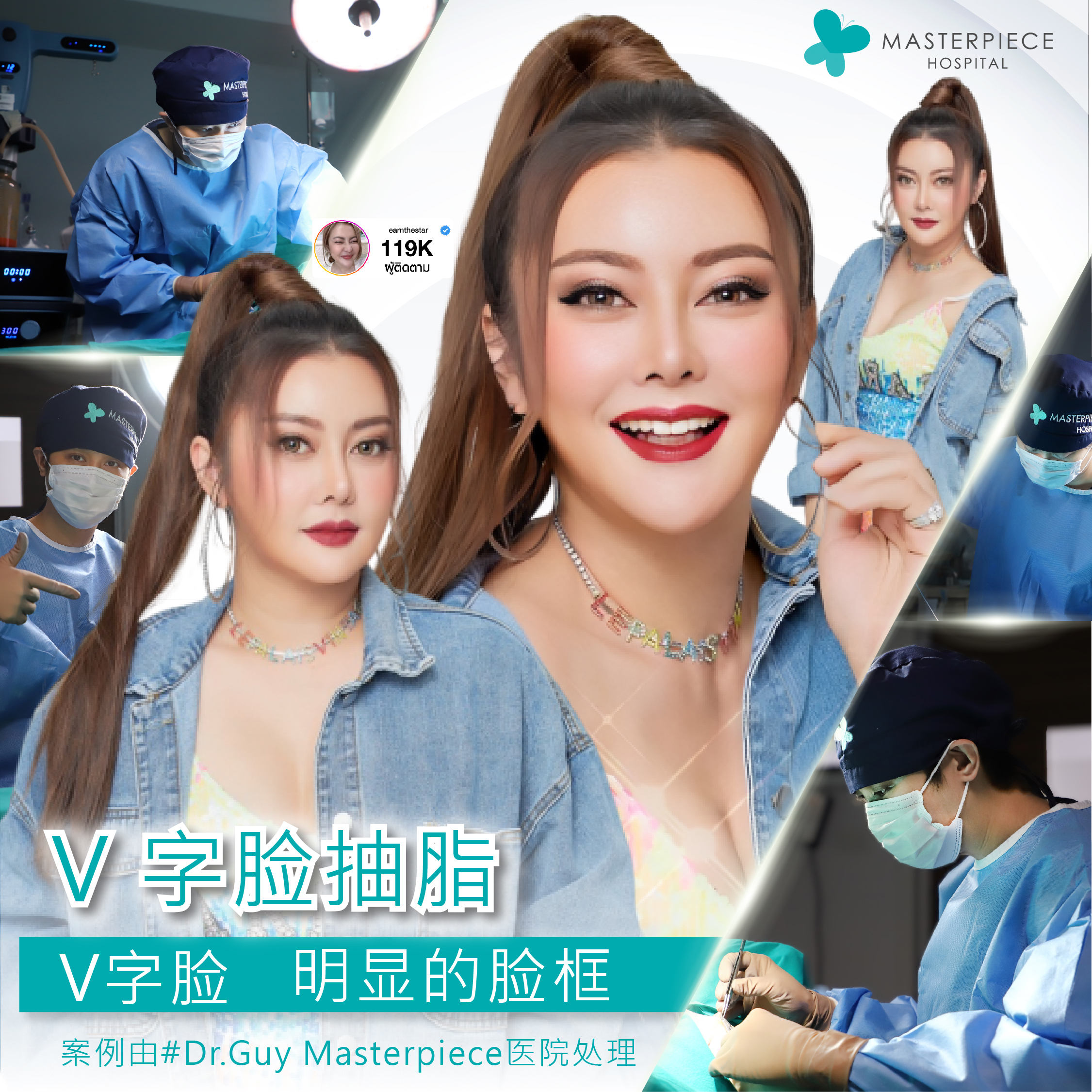 抽脂肪手术的案例