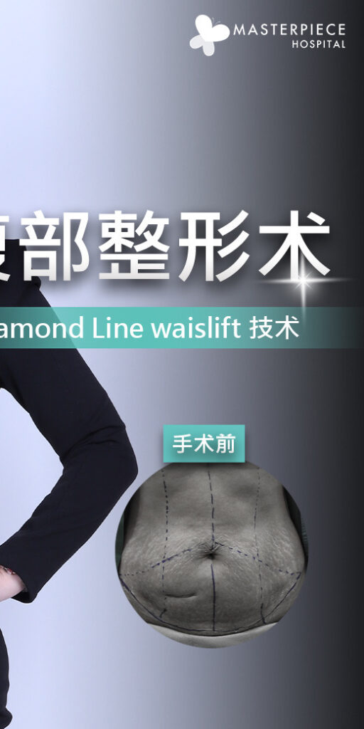 腹部整形手术的案例