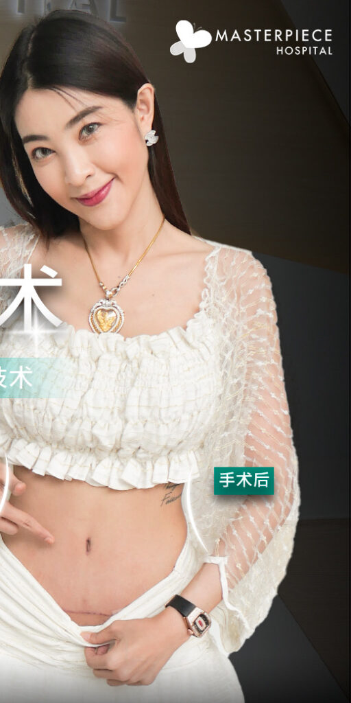 腹部整形手术的案例