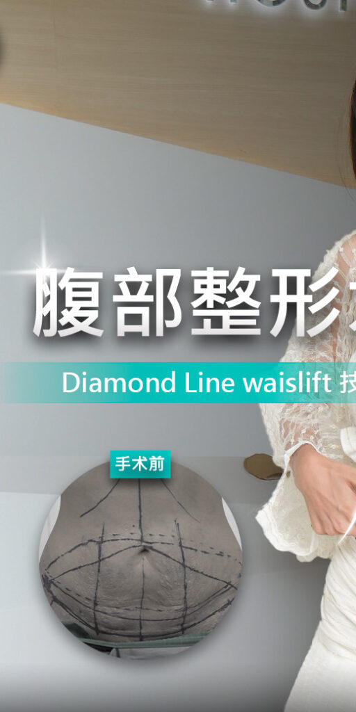 腹部整形手术的案例