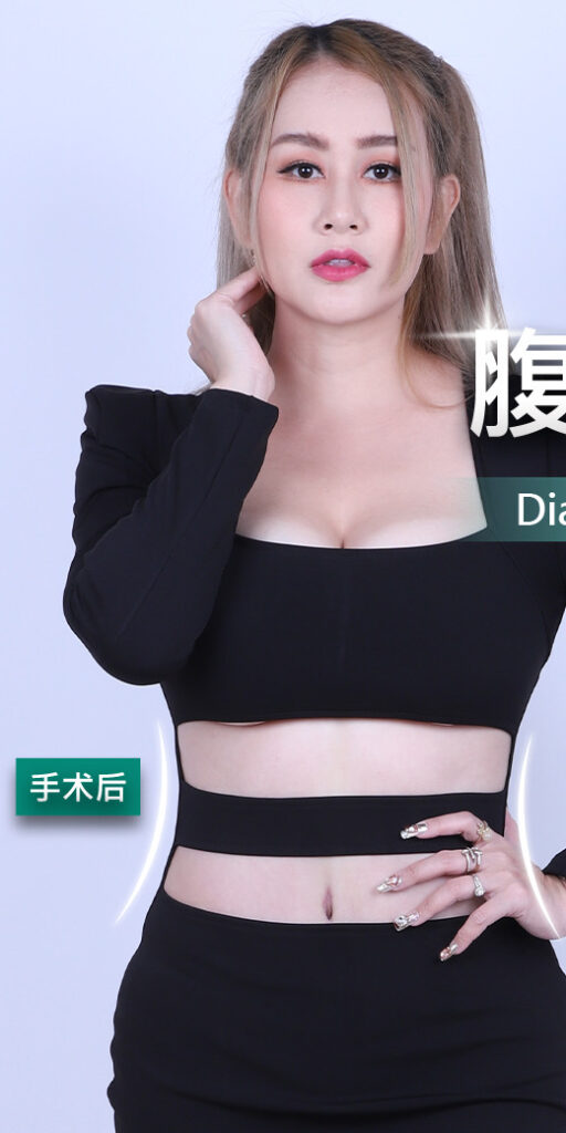 腹部整形手术的案例