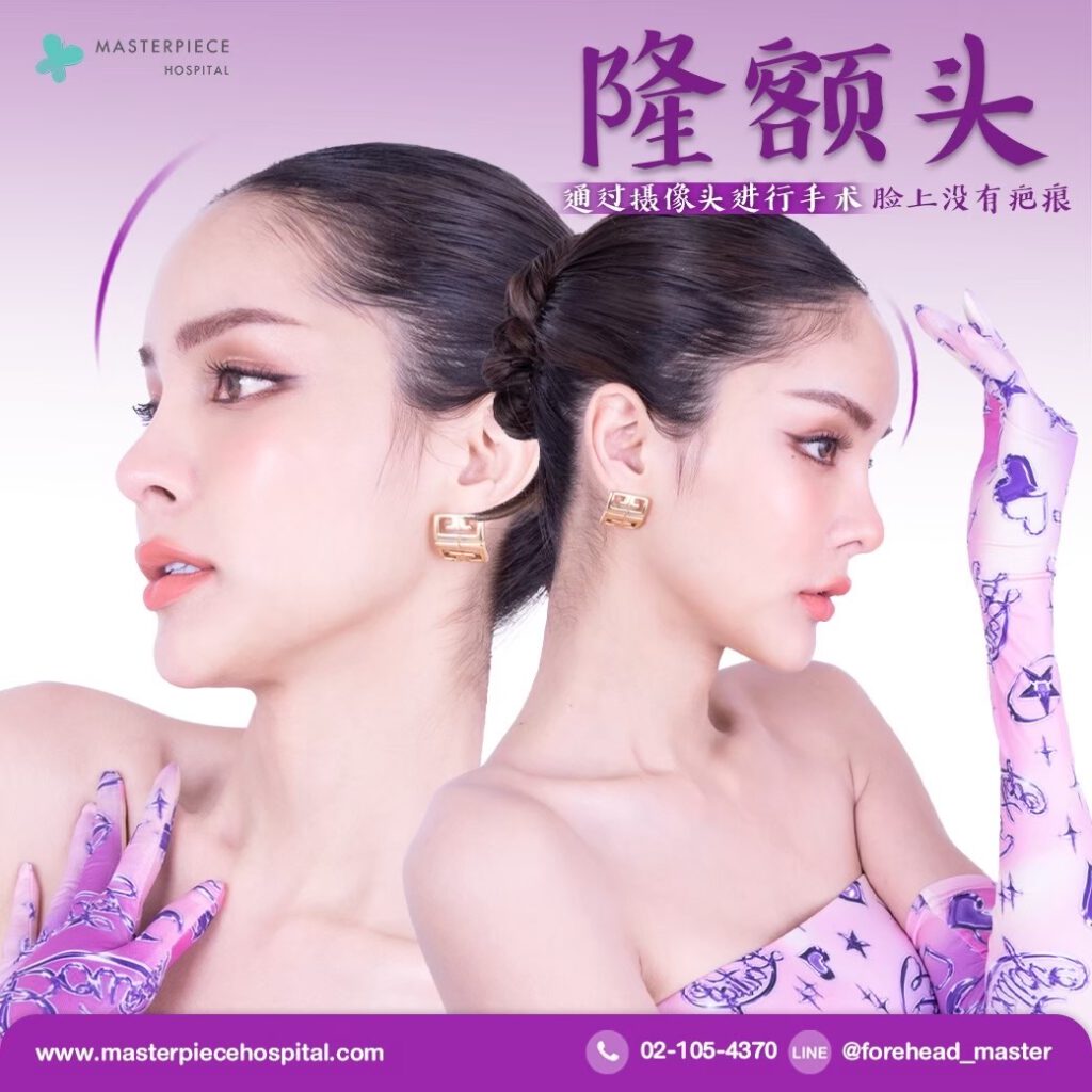 隆额头手术的案例