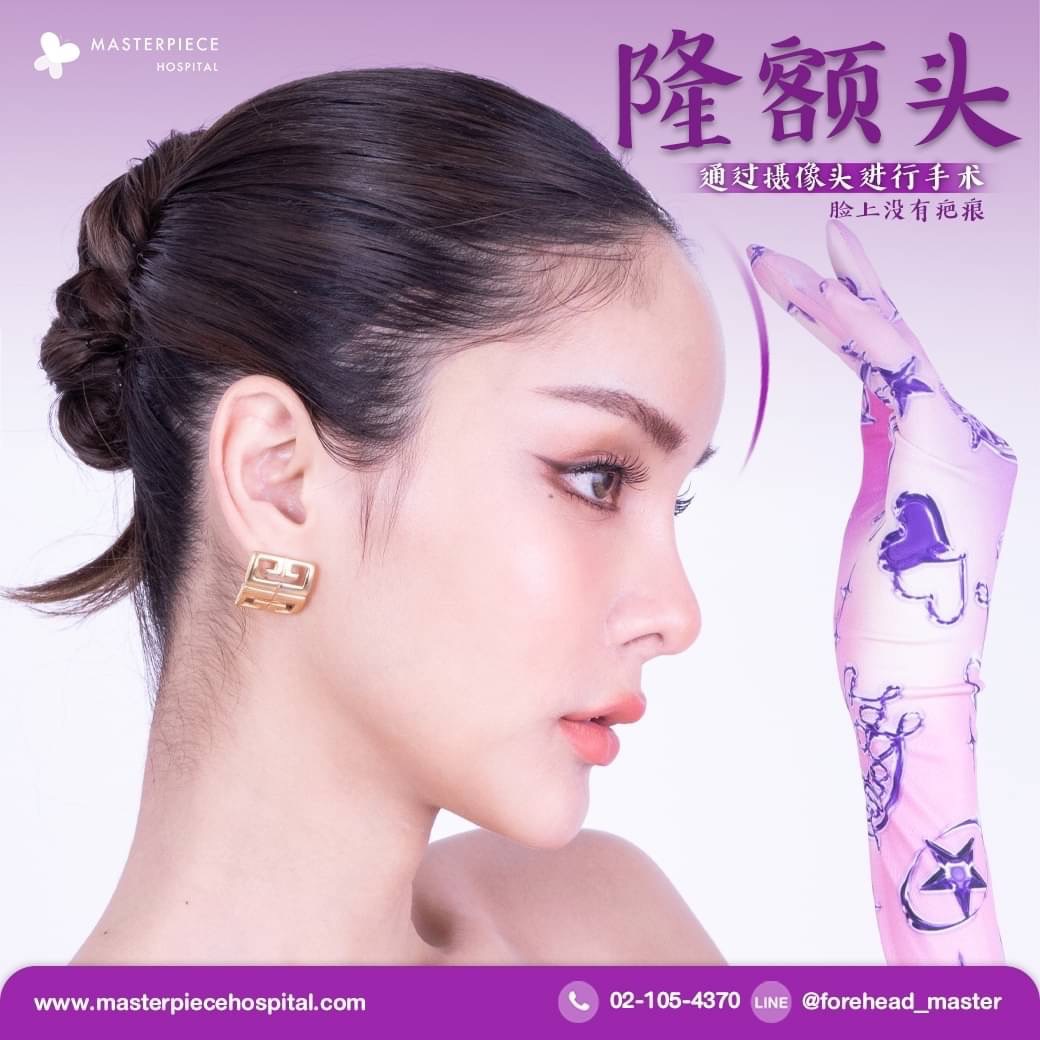 隆额头手术的案例