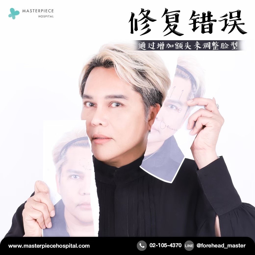 隆额头手术的案例