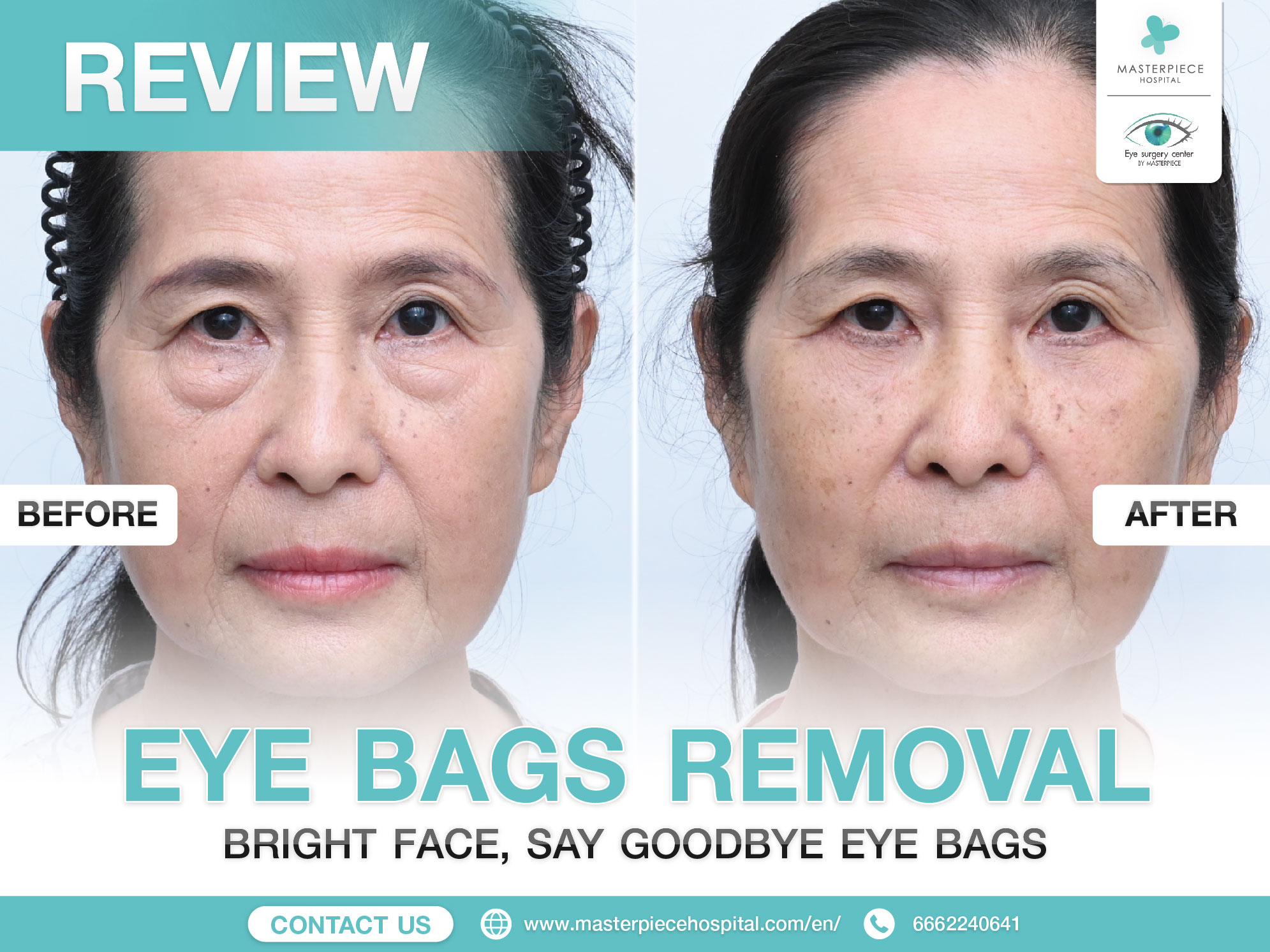Under-eye bag surgery reduces aging signs., image size:1991x1493