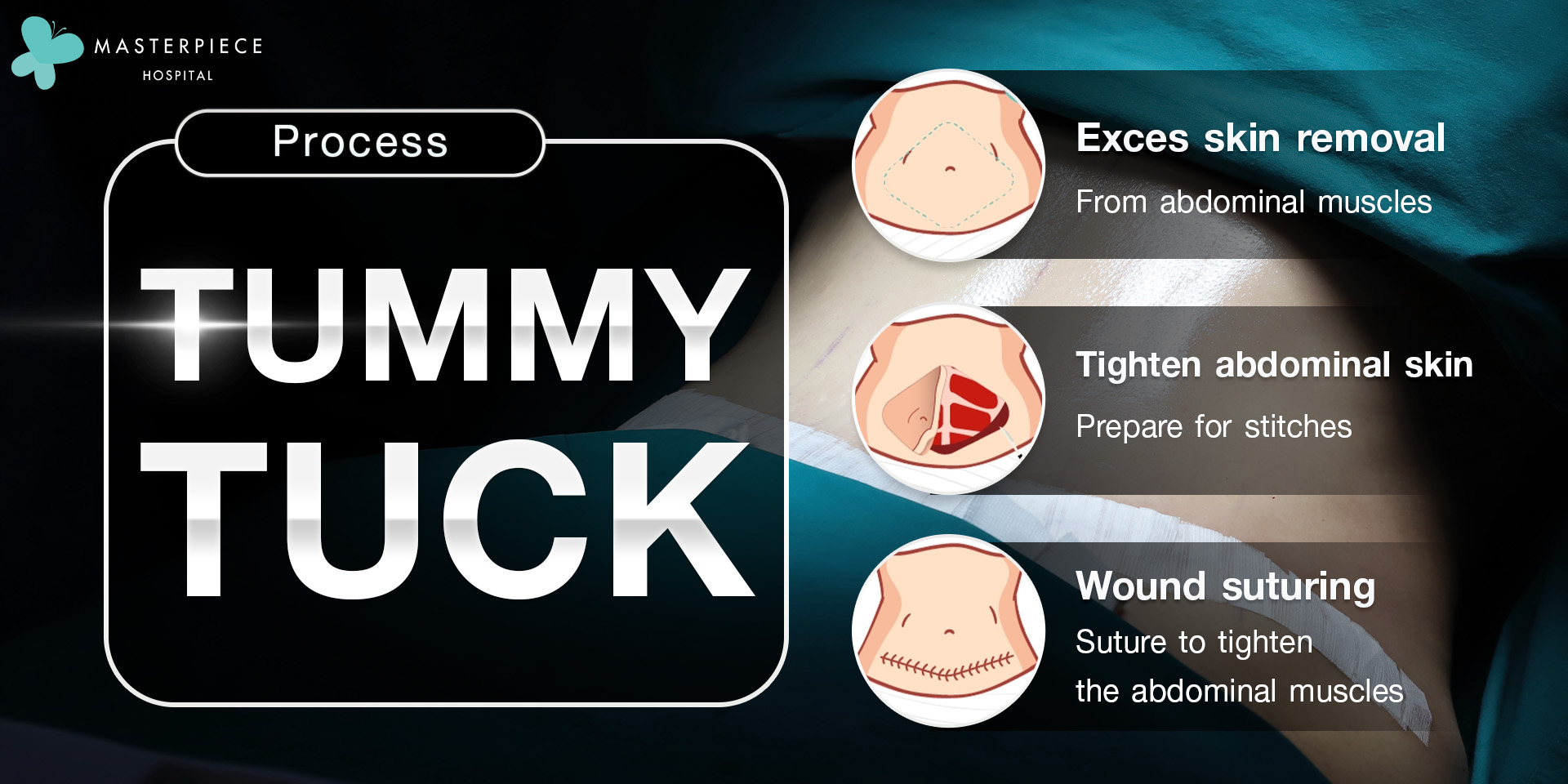 Tummy Tuck: Say Goodbye to Sagging Belly