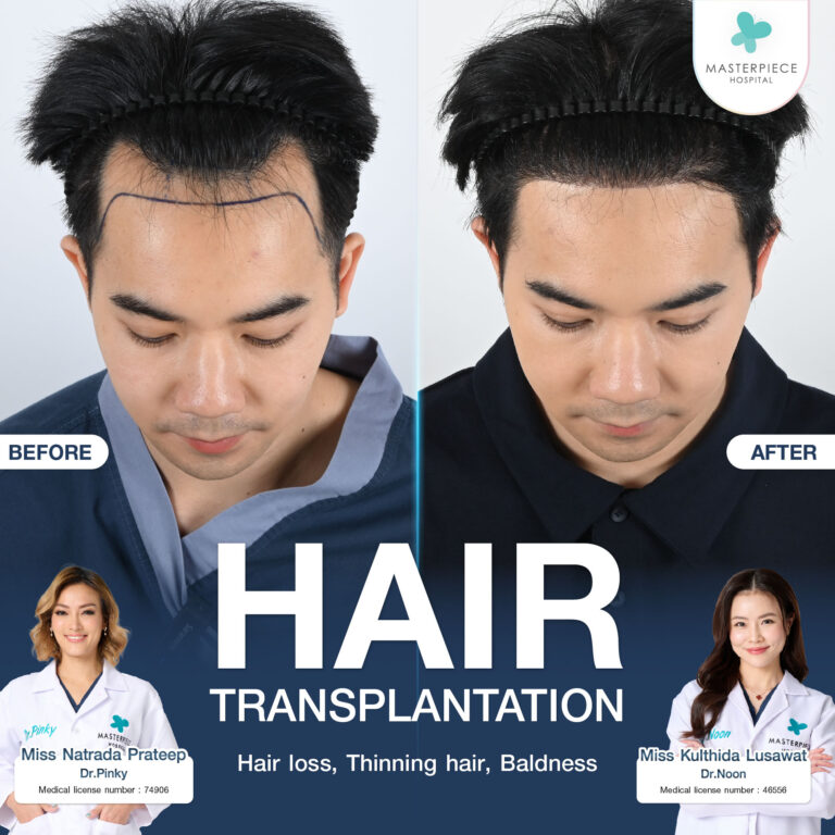 Hair transplantation treats thinning hair and permanently brings hair back to thickness.