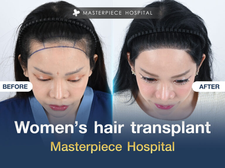 FemaleHairTransplant01