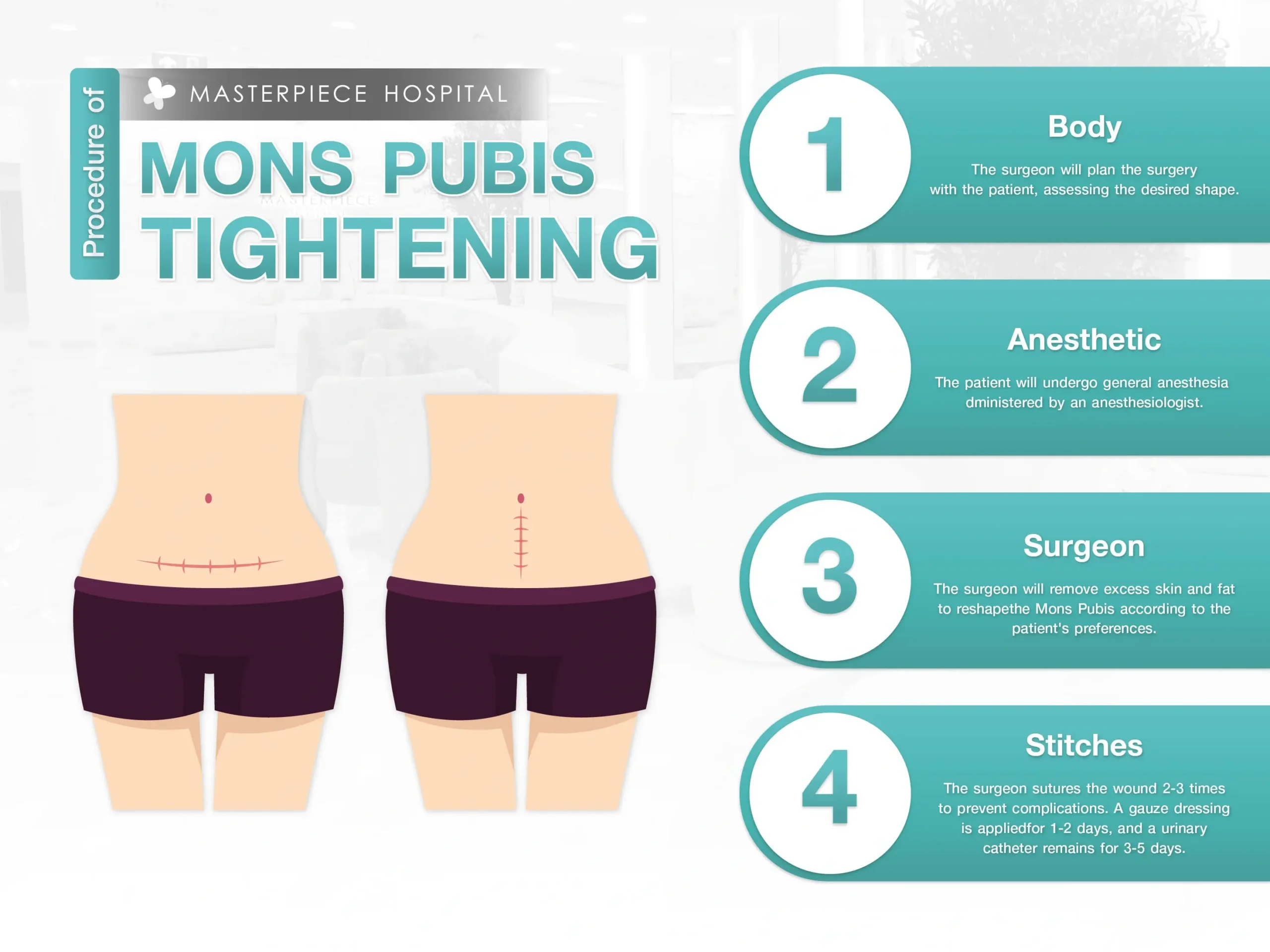 Mons Pubis Tightening procedure