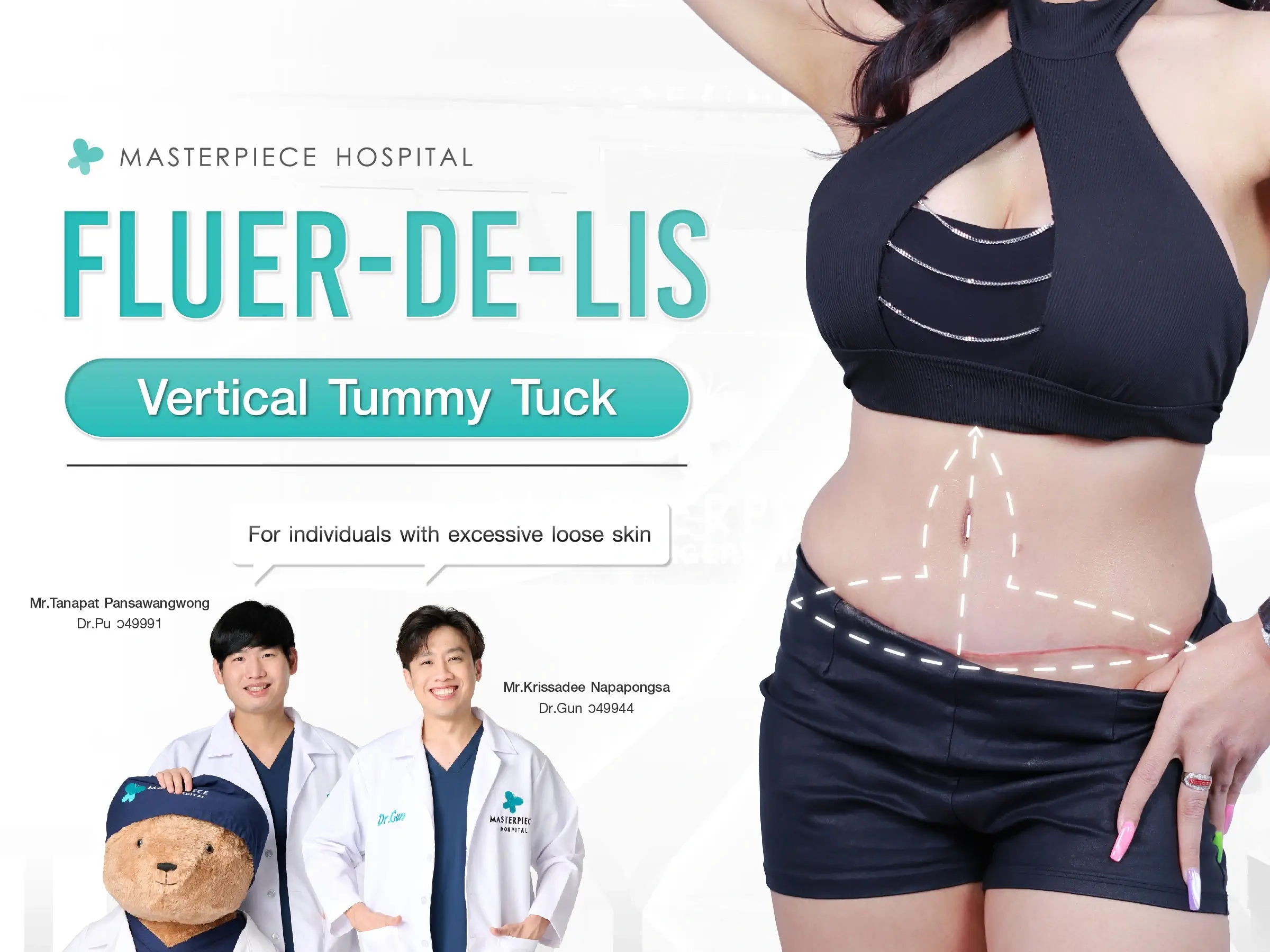 Get to know the Fleur-de-lis Tummy Tuck – vertical abdominoplasty for those with severe skin laxity