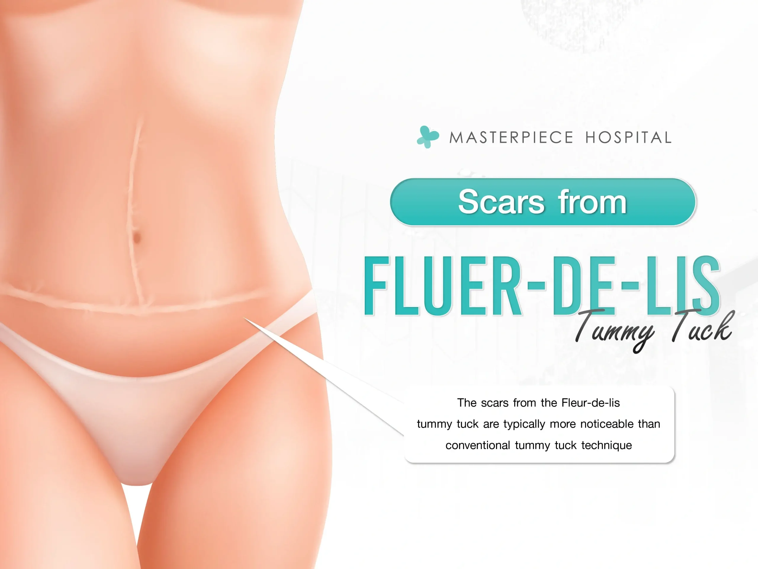 What are the Fleur-de-lis Tummy Tuck scars look like?