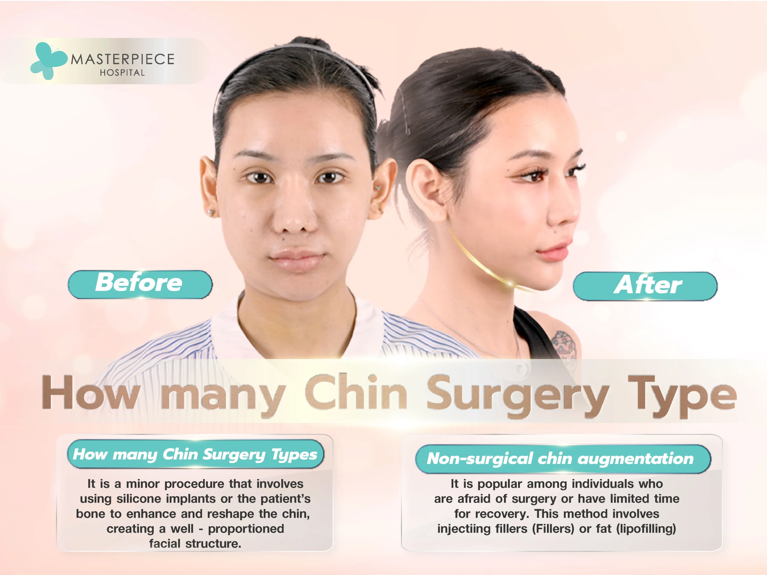 How many types of Chin Surgery are there?