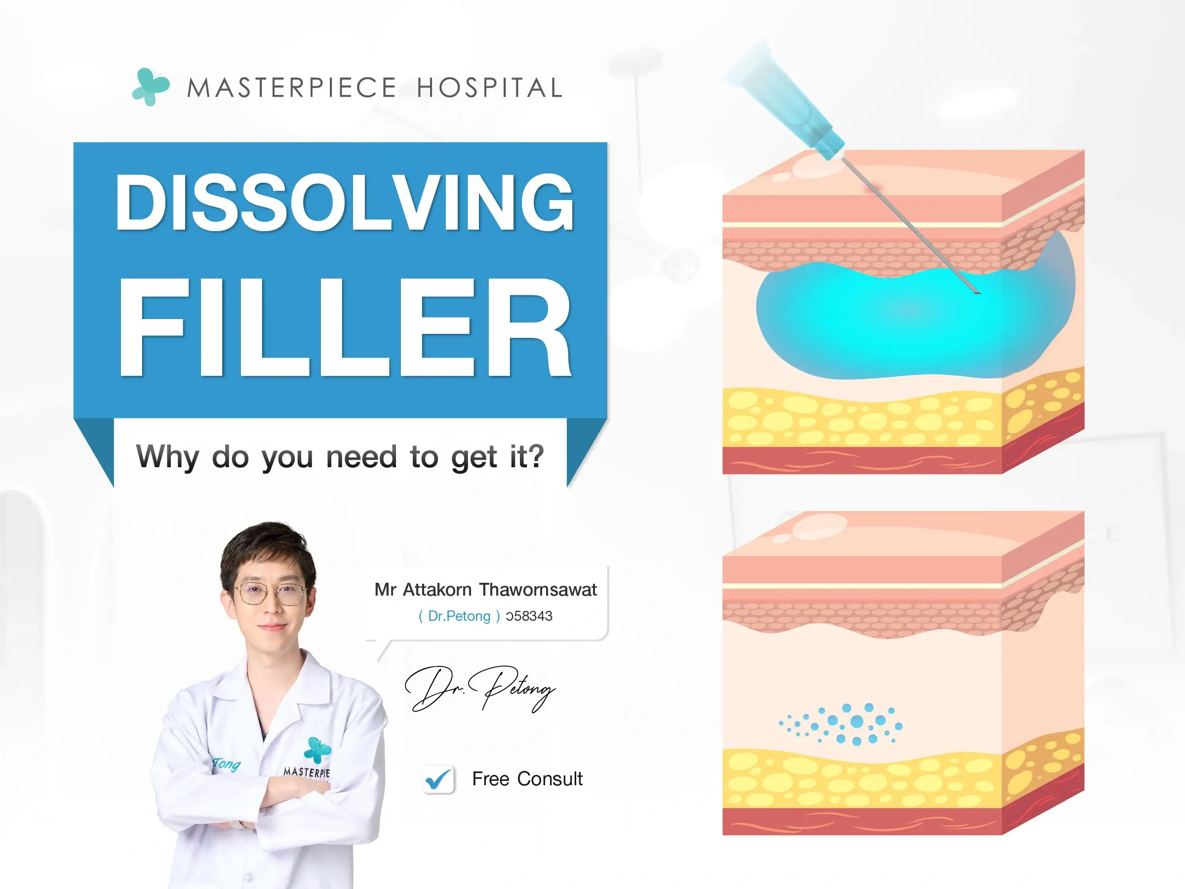 What is Dissolving Filler? Why do you need to get a dissolving filler?